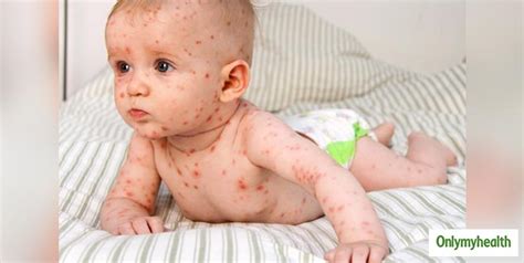 Tips To Identify And Diagnose A Viral Rash In Infants Onlymyhealth