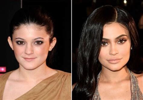 Kylie Jenner Before And After Recherche Google Kylie Jenner Plastic Surgery Kylie Jenner