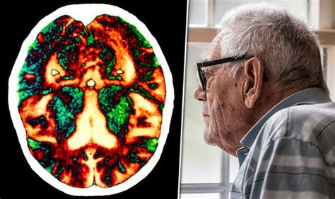 The dementia brain tour is a free educational video resource that includes films on the brain and how brain cells function, alzheimer's disease, posterior cortical atrophy, vascular dementia. Dementia care: Symptoms and signs of early brain decline ...