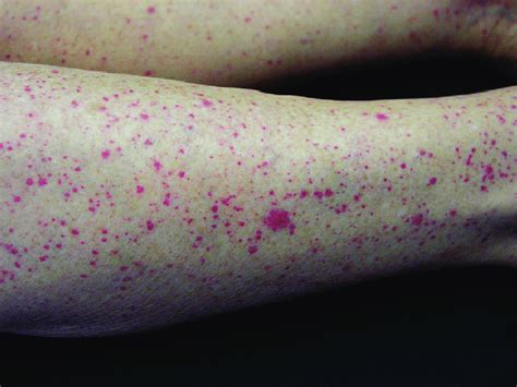 Single And Confluent Purpuric Lesions On Both Legs Download