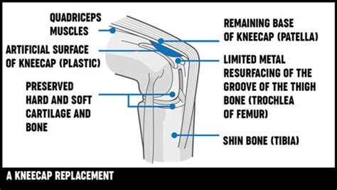 Knee Replacement Surgery Treatment Options Versus Arthritis