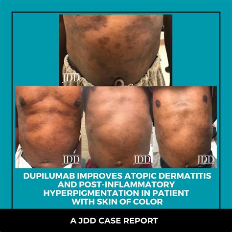 Dupilumab Improves Atopic Dermatitis And Post Inflammatory