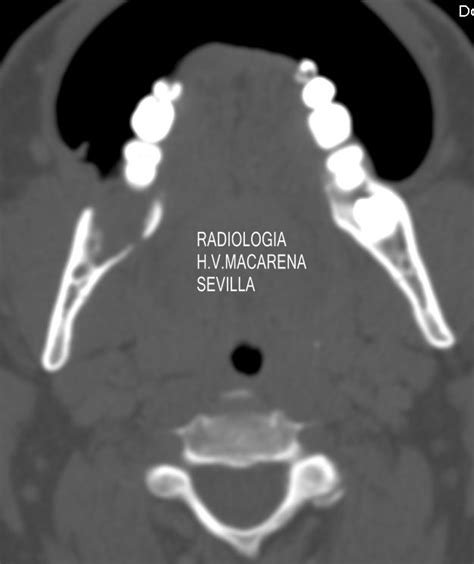 Carcinoma De Trígono Retromolar Radiologia De Cabeza Y Cuello
