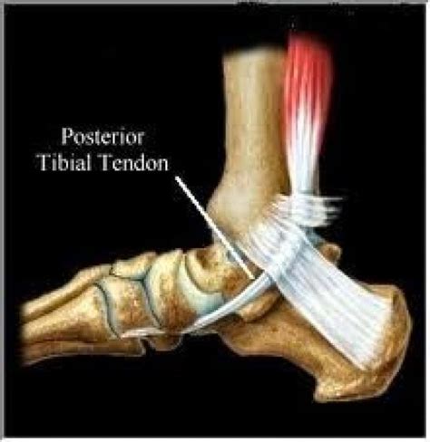 Living With Posterior Tibial Tendon Dysfunction Pttd To Surgery