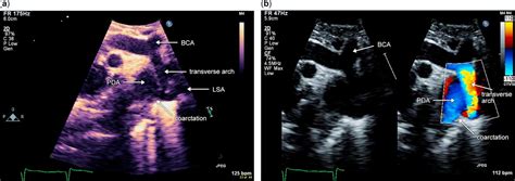 Echocardiography Of Coarctation Of The Aorta Aortic Arch Hypoplasia