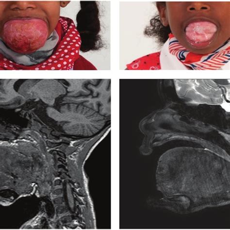 Photograph And Mri Of Lymphatic Malformation Of The Tongue Before And