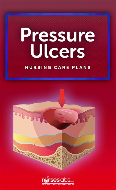 3 Pressure Ulcer Bedsores Nursing Care Plans Nursing Care Plan