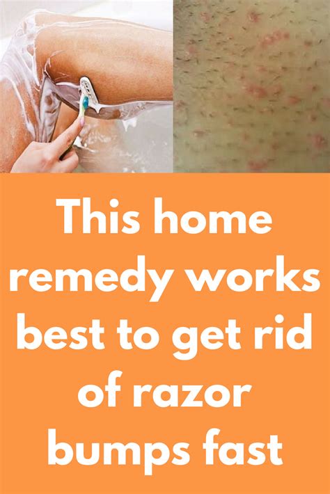 This Home Remedy Works Best To Get Rid Of Razor Bumps Fast In 2020 Razor Bumps Razor Bumps
