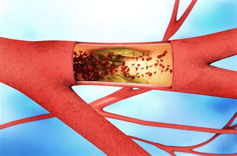 Peripheral Artery Disease Pad Penn Medicine