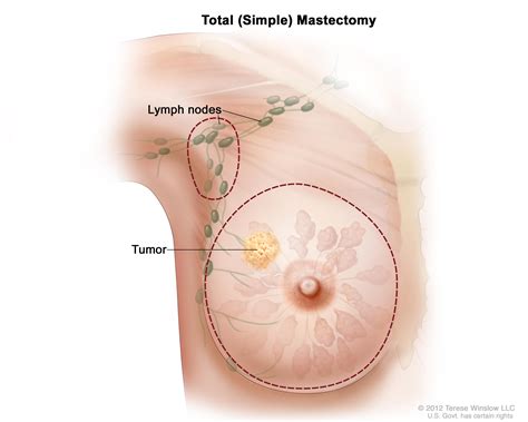 Maybe you would like to learn more about one of these? Breast Cancer Treatment (PDQ®)—Patient Version - National ...