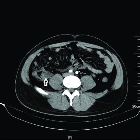 Abdominal Contrast Enhancement Ct Scan Shows An Abscess Lesion Of