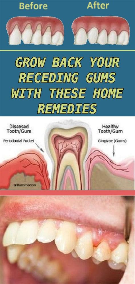 Treat Receding Gums Naturally Using These Methods Healthy Lifestyle