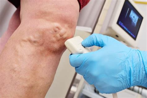Heres What To Expect During Your Microphlebectomy Procedure Nj Vein