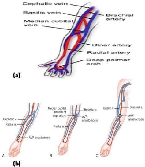 Dialysis Fistula Diagram