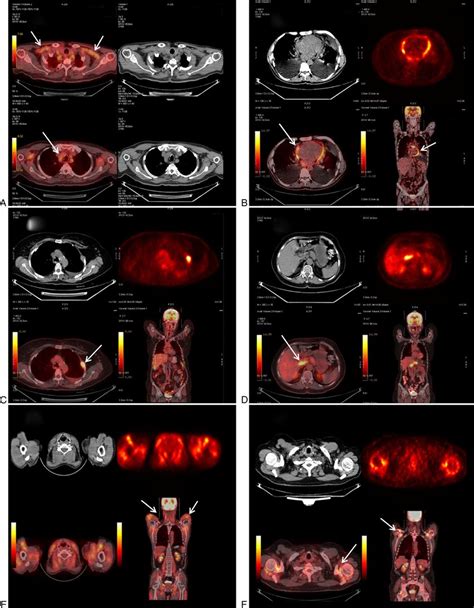 Some Image Examples Of 18 F Fdg Pet Scan Positive Subjects A A