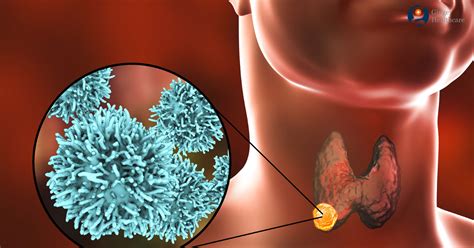 Symptoms can include swelling or a lump in the neck. Thyroid Cancer: Causes, Symptoms, Diagnosis & Treatment ...