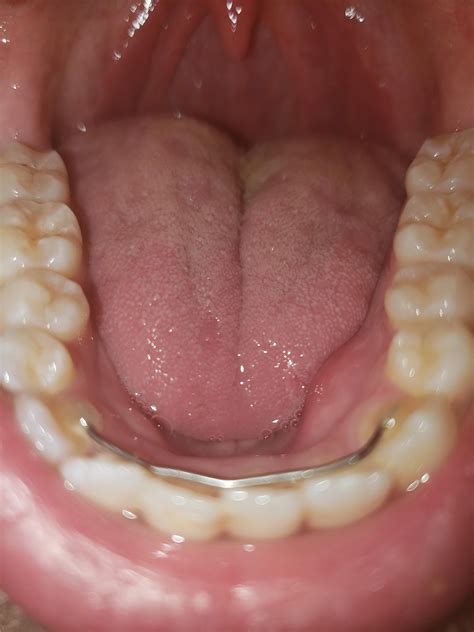 Hard Lump Below Left Premolarscanine Above Floor Of Mouth Raskdocs