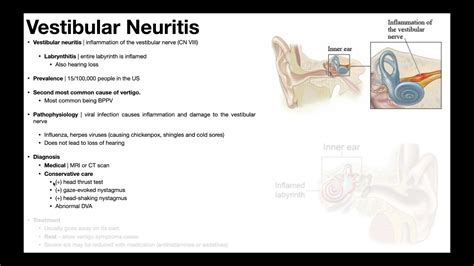 👂 Vestibular Neuritis Presentation Pathophysiology Diagnosis