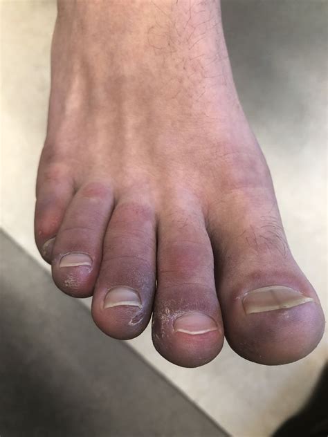 A Year Old Male Has Persistent Purple Toes And New Red Lesions On