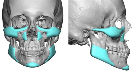 Custom Jaw Implants Chin Implants Eppley Custom Facial Implants