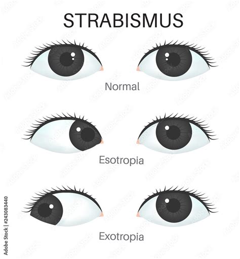 Types Of Strabismus Esotropia And Exotropia Stock Vector Adobe Stock