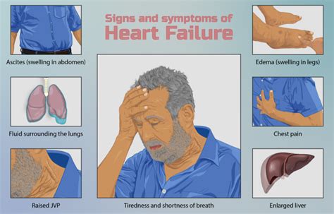 Heart Failure Physiopedia