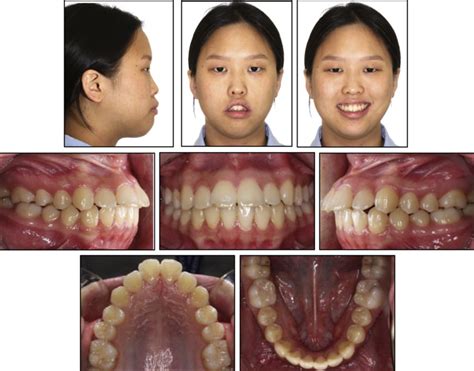 Correction Of Severe Bimaxillary Protrusion With First Premolar