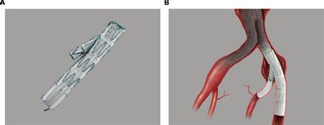 Hypogastric Preservation During Treatment Of Aortoiliac Aneurysms
