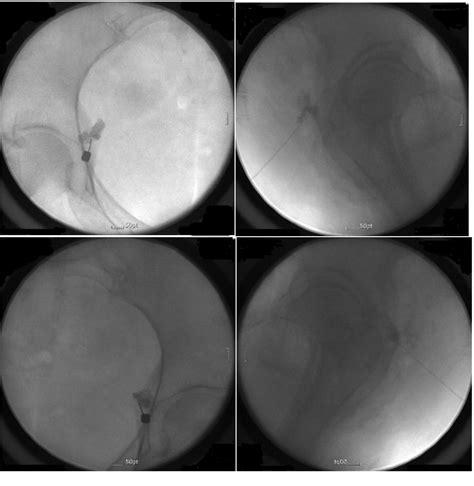 Figure From Treatment Of Radiation Induced Vulvar Pain Via Pudendal Nerve Block Under