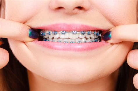 Types Of Dental Braces Teeth Straightening Methods Explained Tooth
