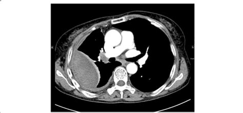 Chest Cta Showed Encapsulated Pleural Effusion With Atelectasis On The