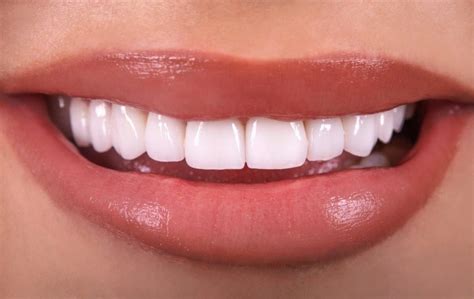 What Do Teeth Look Like Under Veneers