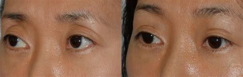 Upper Eyelid Fillers Los Angeles Taban Md Oculoplastic Cosmetic