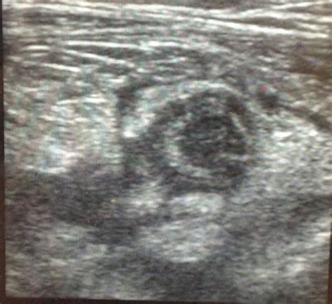 Ultrasound 7 Acute Appendicitis Emhum