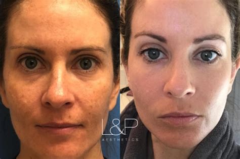 Halo Face Treatment Before And After Your Magazine Lite