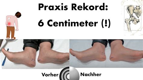 6 Cm Beckenschiefstand Beinlängendifferenz Korrektur Rückkehr In Die Natürliche Ordnung