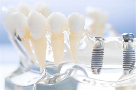 Santa Rosa Oral Surgeons Make Your Implant Placement Comfortable With