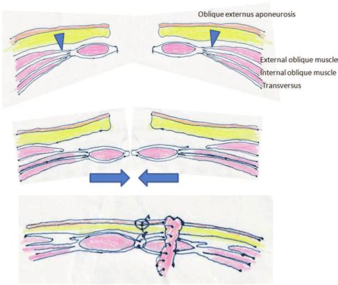 Schematic Illustration Of Abdominal Wall Repair With The Component