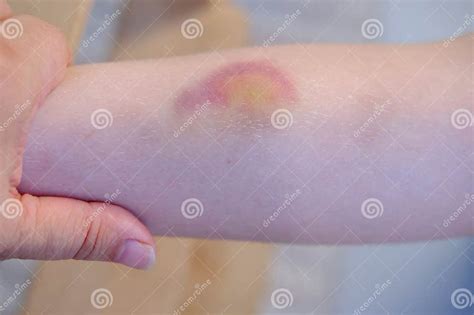 Bruise Child S Leg Wound Healing Process In Child Childhood Accidents