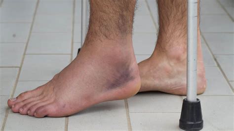 Sprained Ankle Vs Broken Ankle Explained By A Foot Specialist