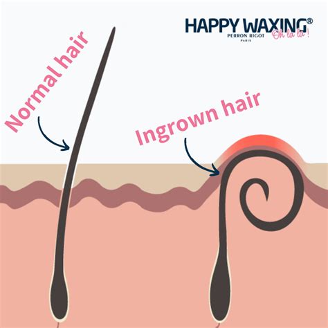 How To Prevent Ingrown Hairs After Waxing