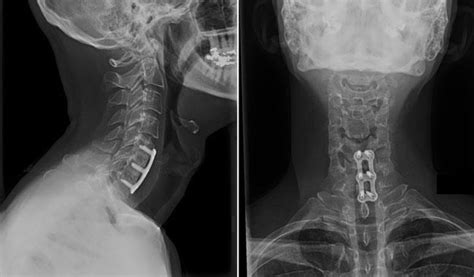 Cervical Radiculopathy Surgical Treatment Options Orthoinfo Aaos