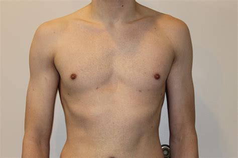 Gynecomastia Before And After Pictures In Norwich Ct Connecticut Surgical Arts