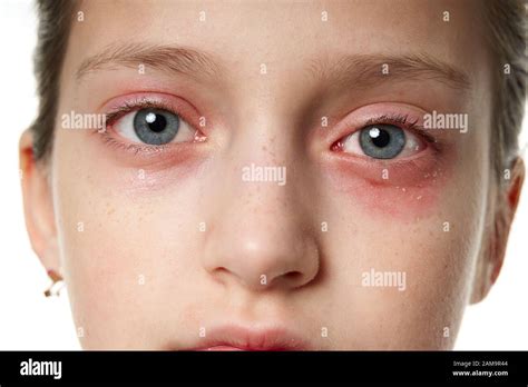 Allergic Reaction Skin Rash Close View Portrait Of A Girls Face