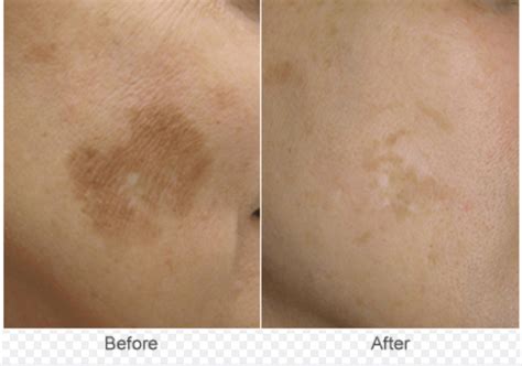 Skin Classic Skin Irregularity Treatment Allure Spa And Skin Health