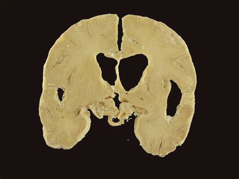 Coronal Section Of Human Brain Plastinated Specimen With 5 Parts