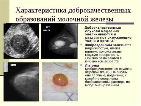 Фиброаденома молочной железы диета Фиброаденома молочной железы - лечение доброкачественной опухоли Фиброаденома молочной железы - лечение доброкачественной опухоли Фиброаденома молочной железы диета