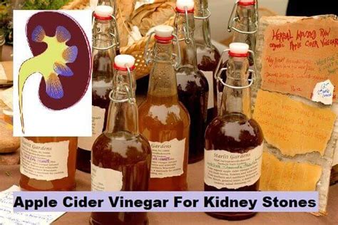 5 Mixture Of Apple Cider Vinegar For Kidney Stones 2024