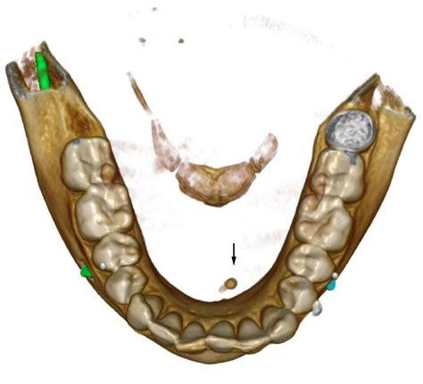 Sialolithiasis Salivary Gland Stone Salivary Gland Calculus