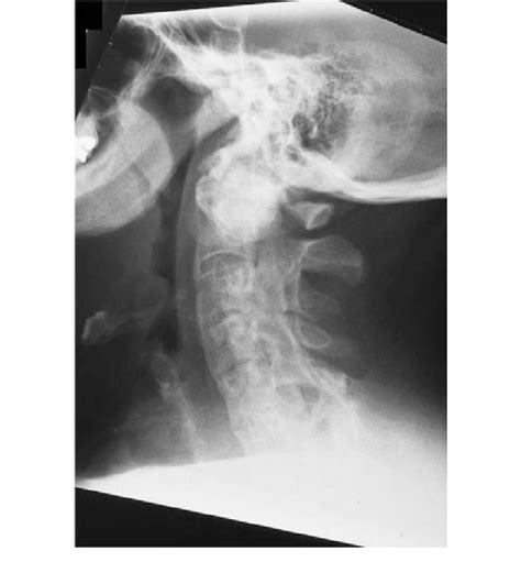 Plain Radiograph The Cervical Spine With No Obvious Fracture Download